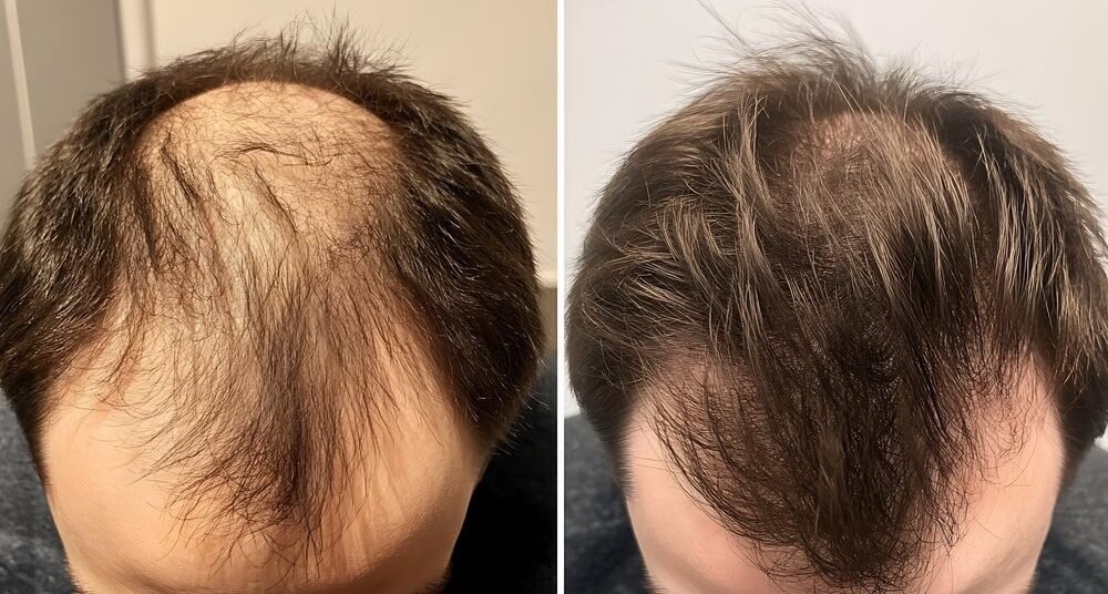 Before And After Hair Transplant - The Hair Mission